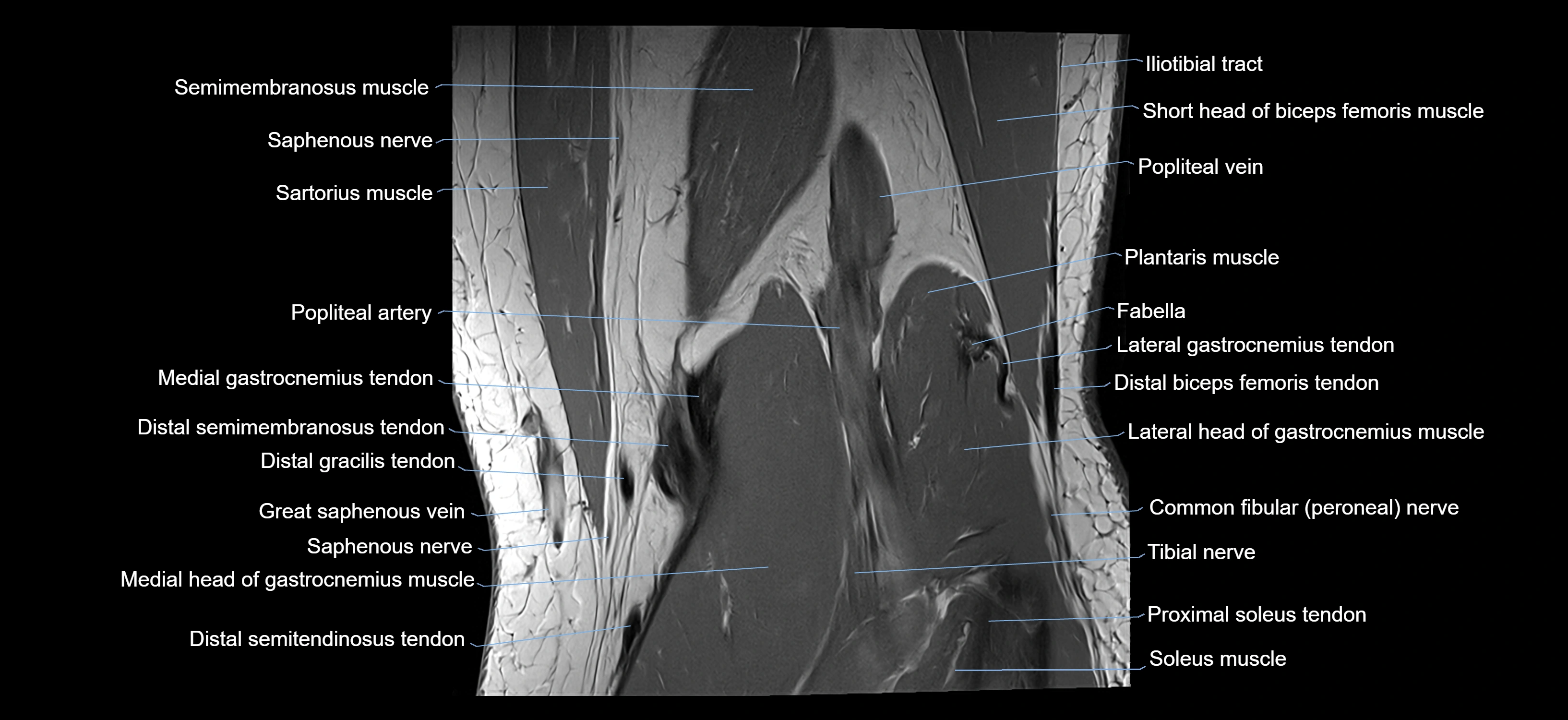 MRI knee coronal cross sectional anatomy labelled 3T radiology  image-04001-00032.webp